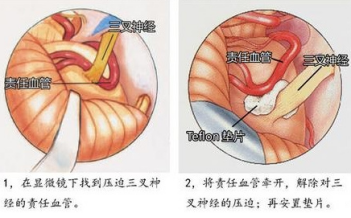 三叉神经痛