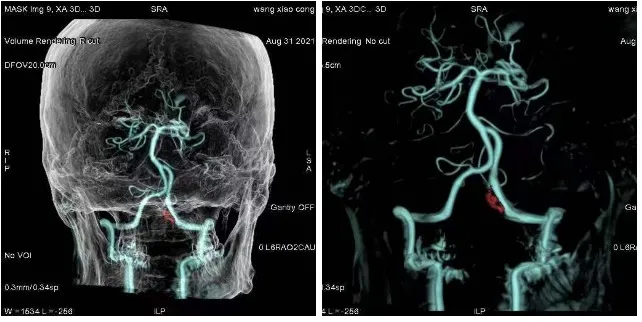 双板DSA脑部3D动态图